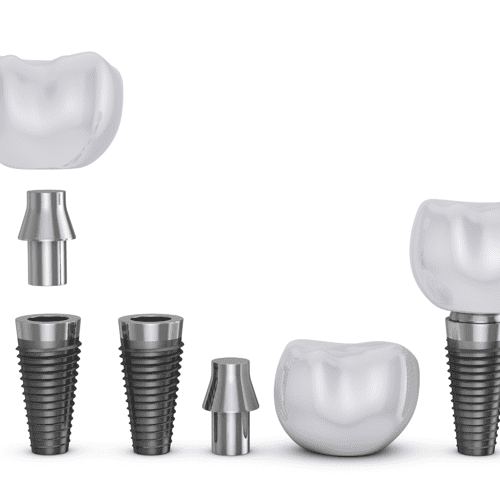 Guide to Dental Implants in San Miguel De Allende, Mexico